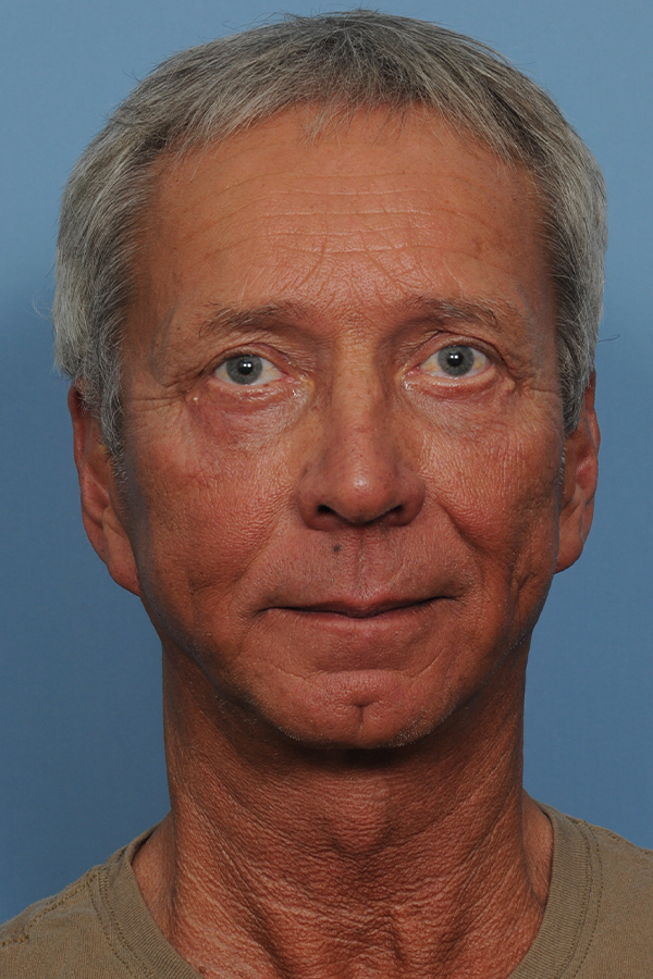 procedure after