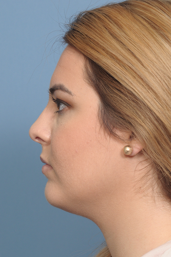 procedure after