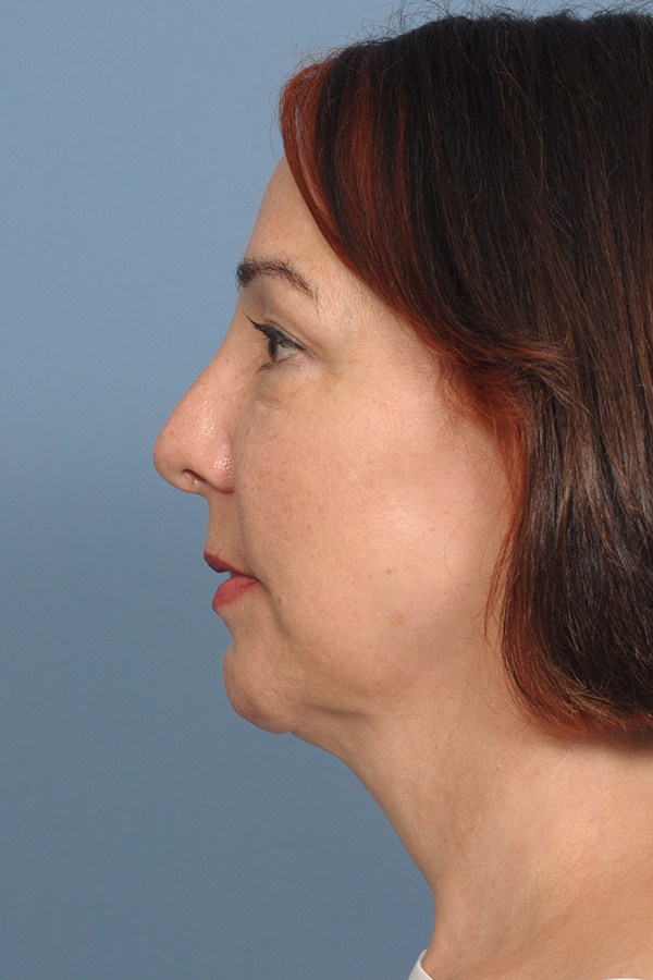 procedure after