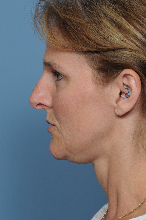 procedure after
