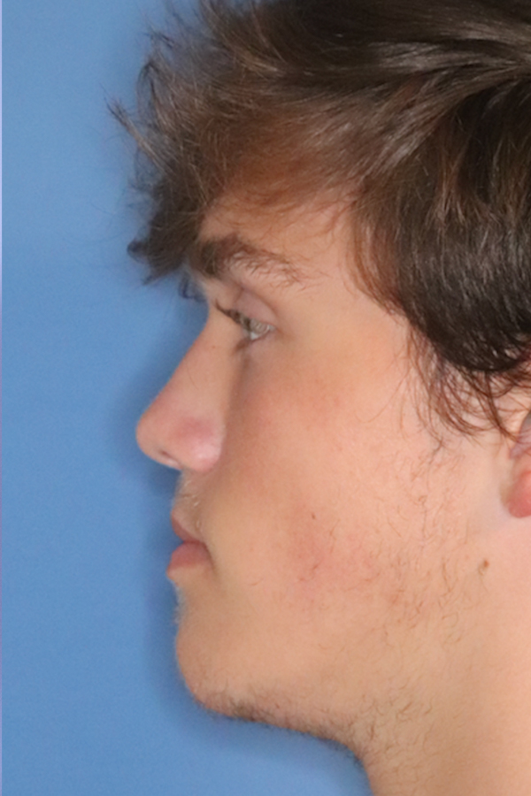 procedure after