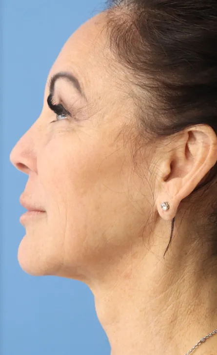 procedure after