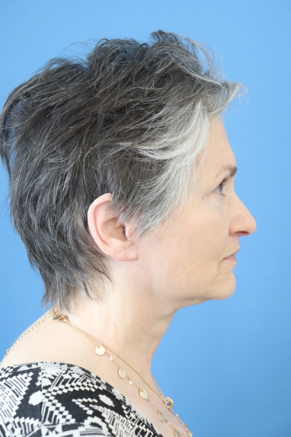 procedure after