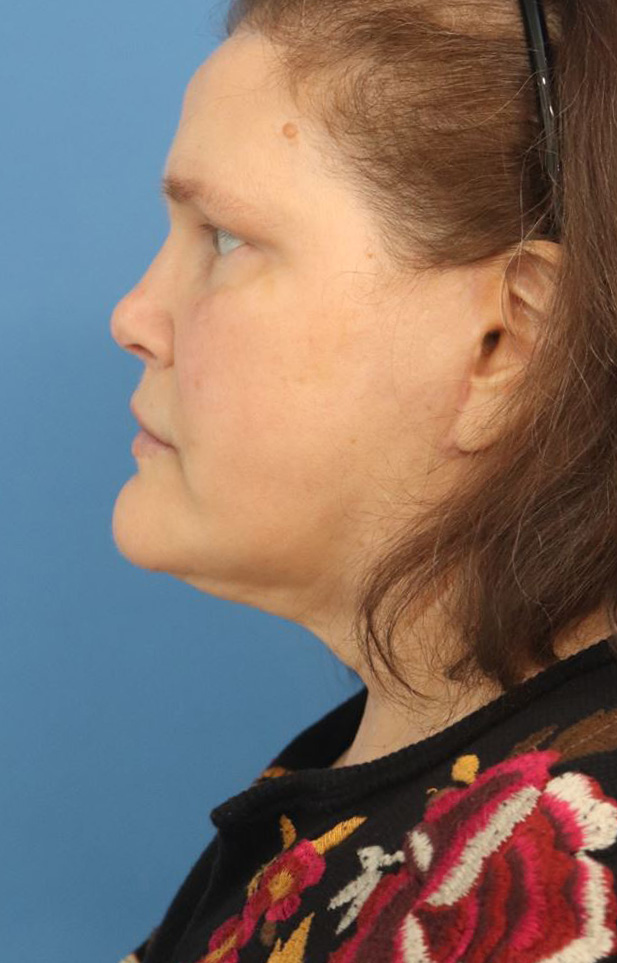 procedure after