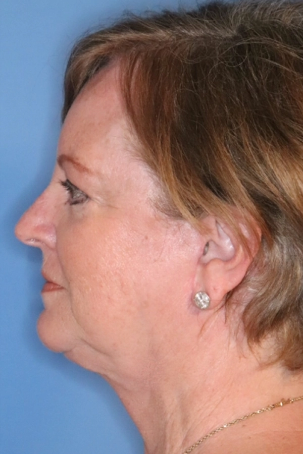 procedure after