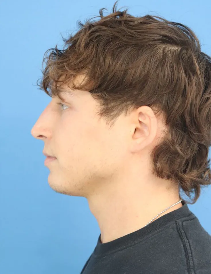 procedure after