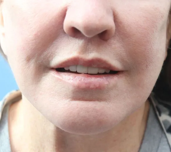 procedure after