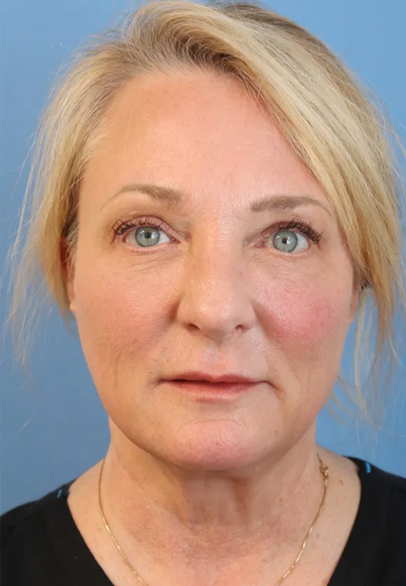 procedure after