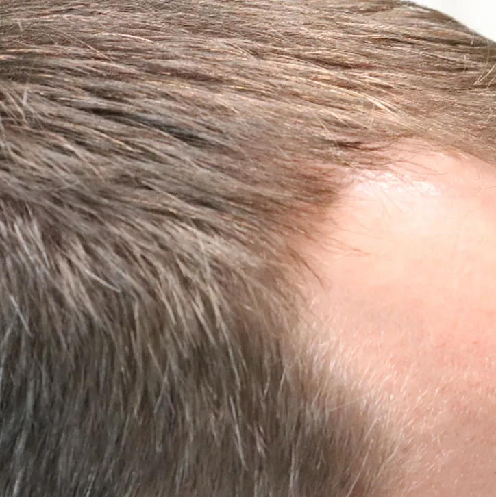 procedure after