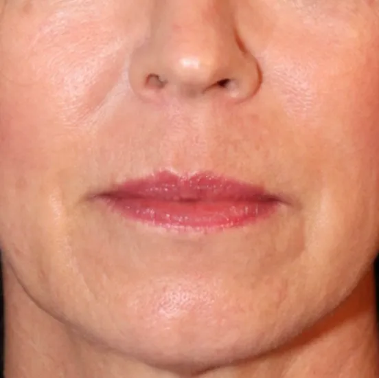 procedure after