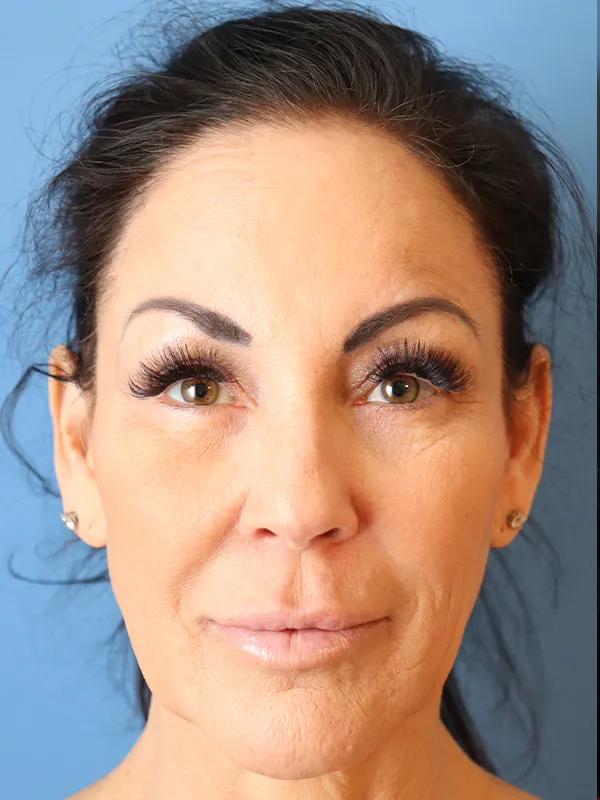 procedure after