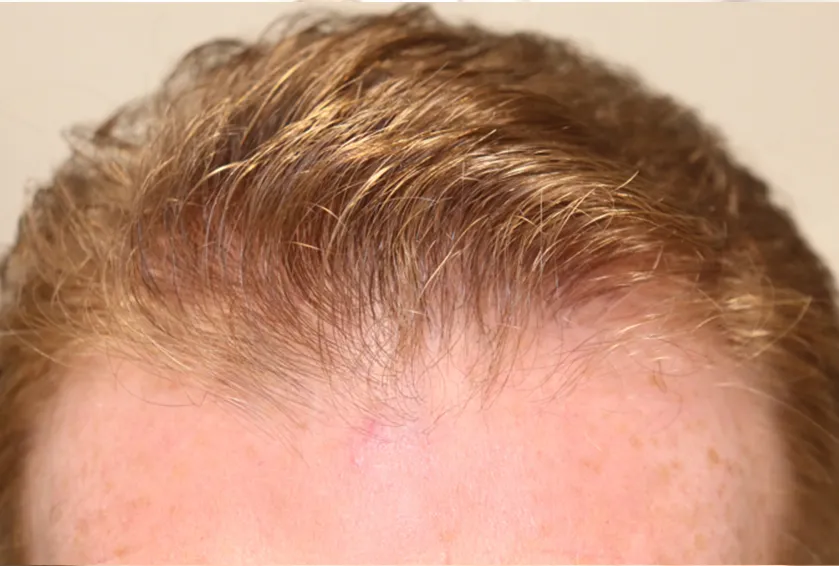 procedure after