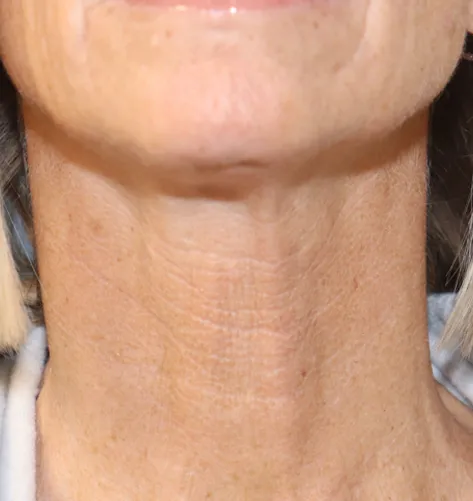 procedure after