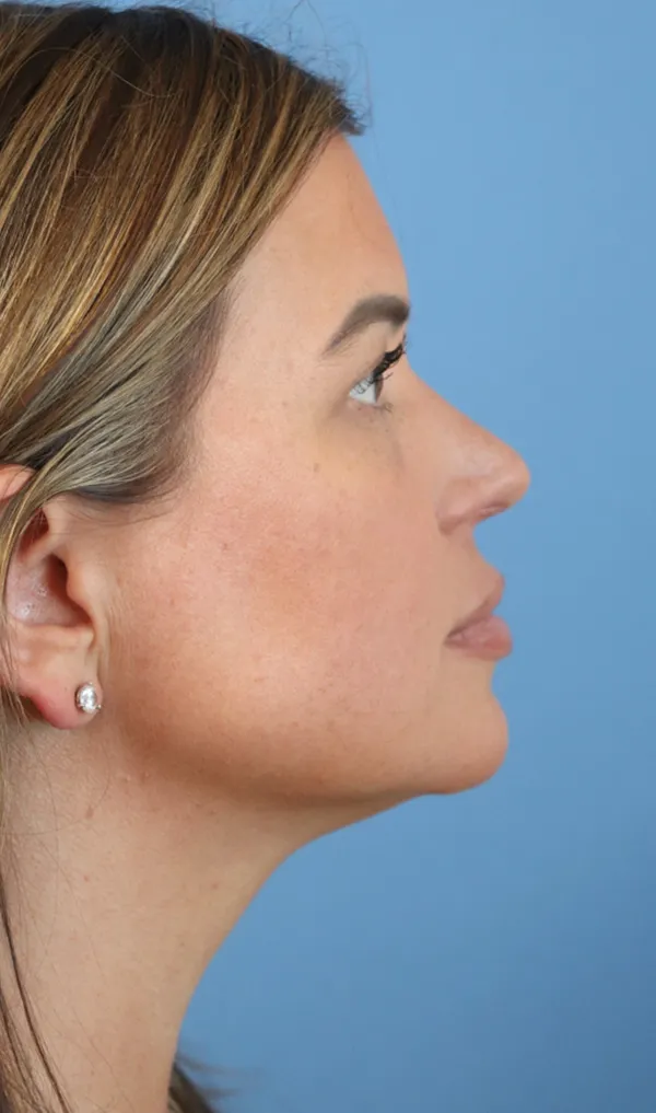 procedure after
