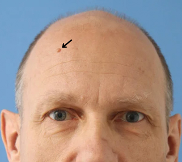 Before A