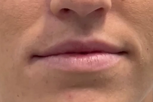 Before A