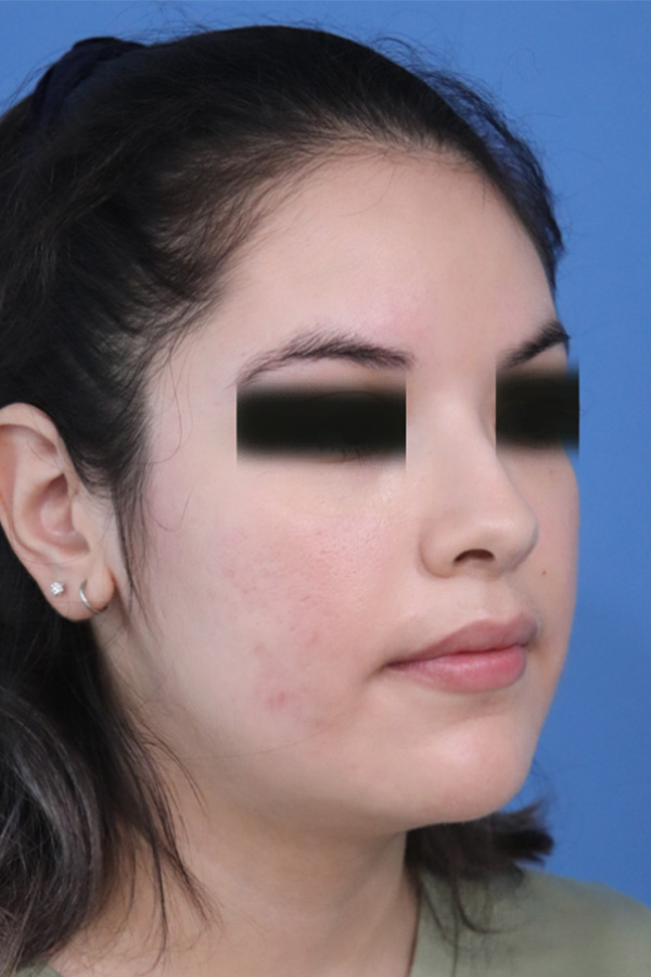 Before A