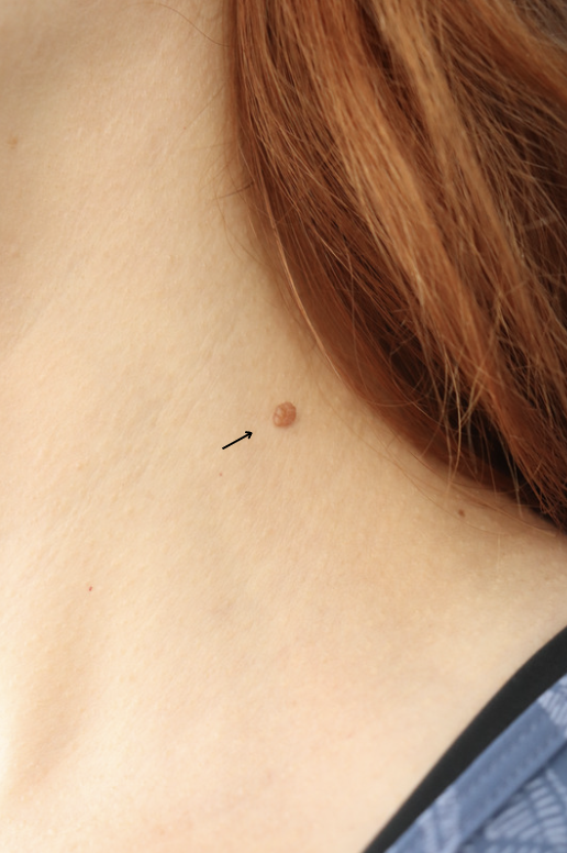 Before A