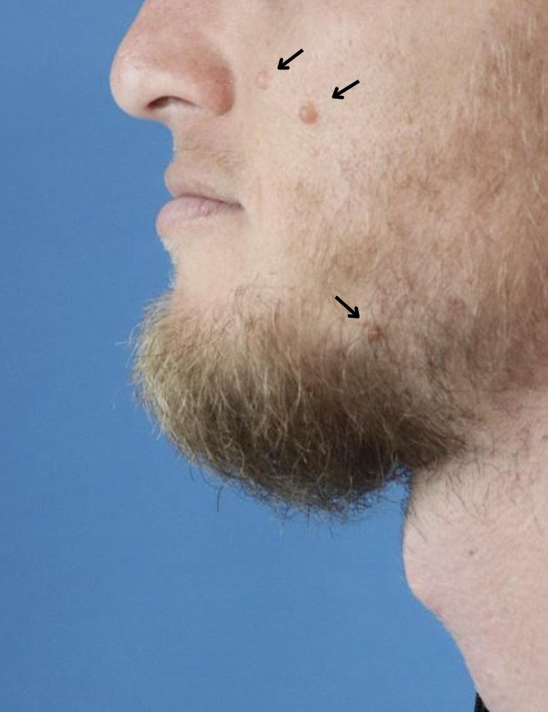 Before A